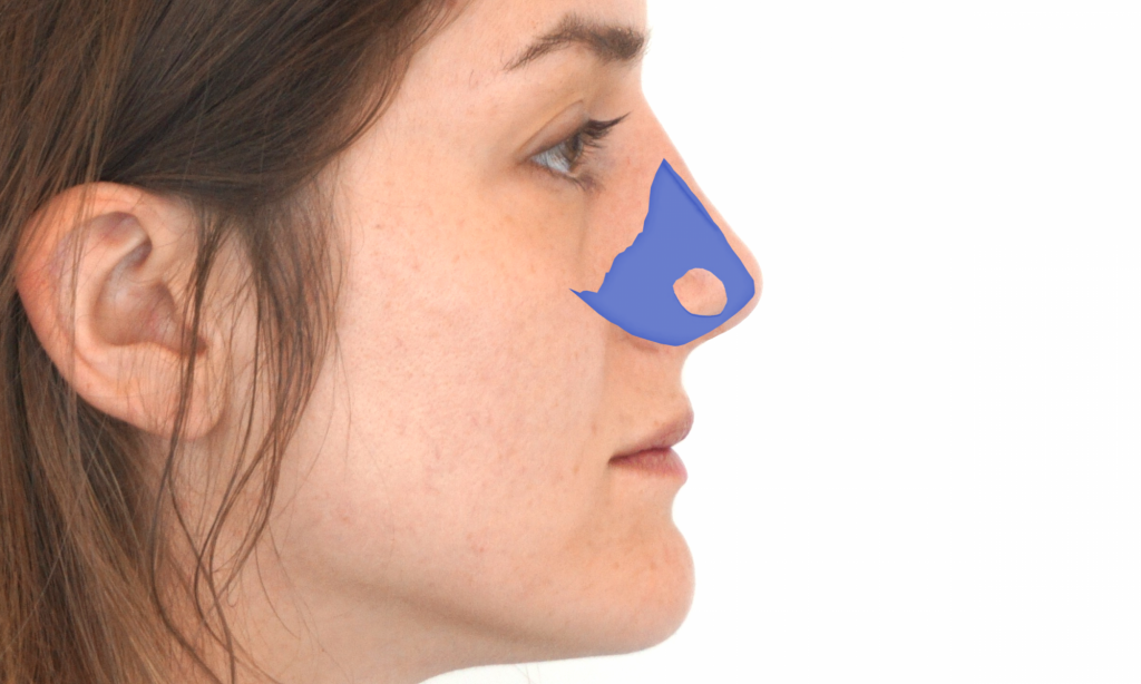 Wann soll ich operieren? - Septumperforation - Loch in der